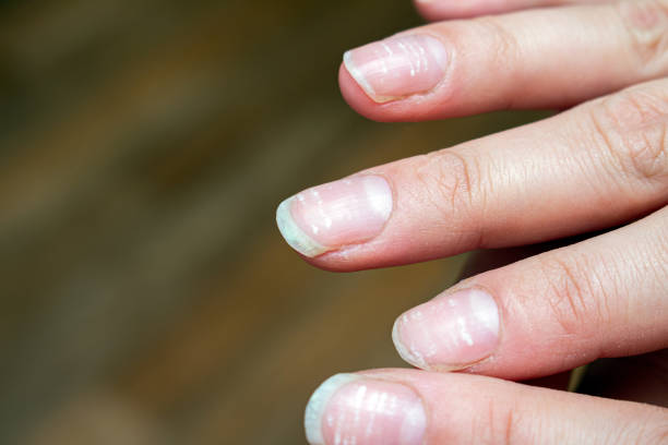 1,958 White Spots On Nails Stock Photos, Pictures & Royalty-Free Images -  iStock | Nail fungus