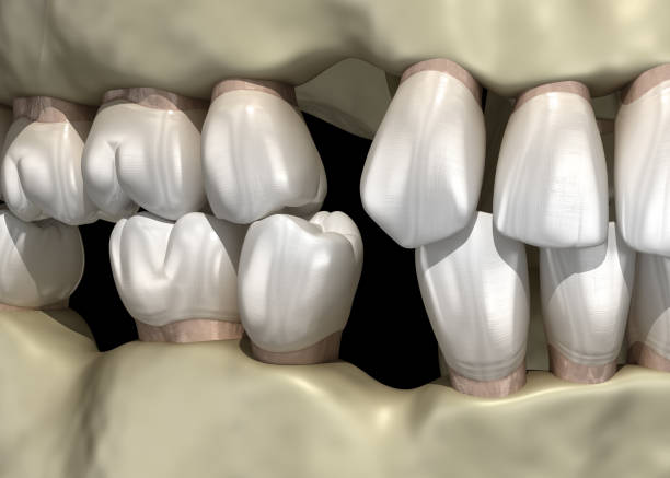 istock Teeth shift deformatiuon after losing teeth. 3D illustration of Popov Godon phenomenon 1279174028