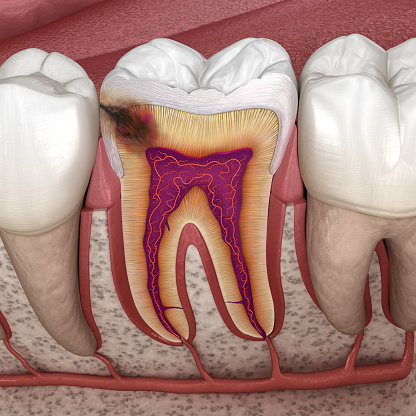 Hidden caries in to molar tooth. Medically accurate 3D illustration
