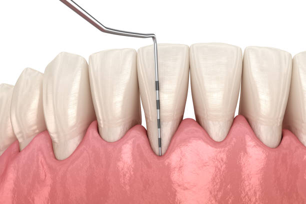 istock Gum recession test. Medically accurate 3D illustration 1279174282