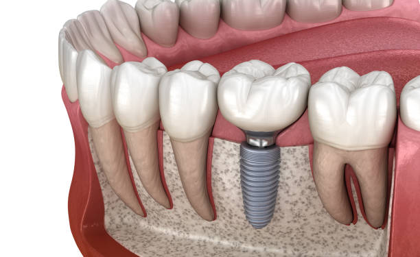 instalación de la corona de dientes molar sobre el pilar del implante. ilustración 3d médicamente precisa del concepto de dientes y dentaduras postizas humanas - premolar fotografías e imágenes de stock