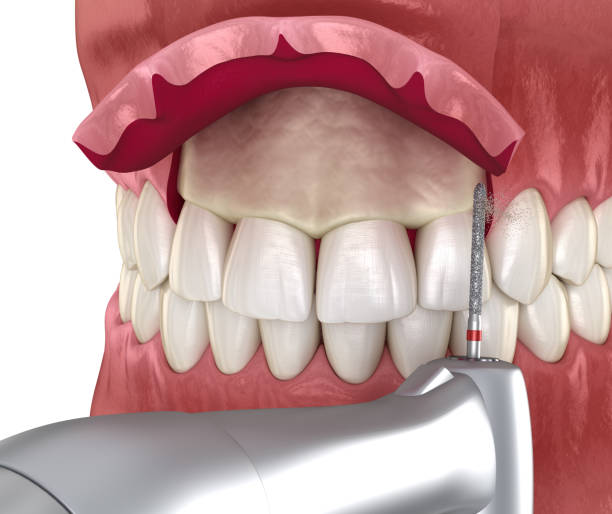 istock Frontal crown lengthening, Esthetic surgery. Medically accurate dental 3D illustration 1279174327