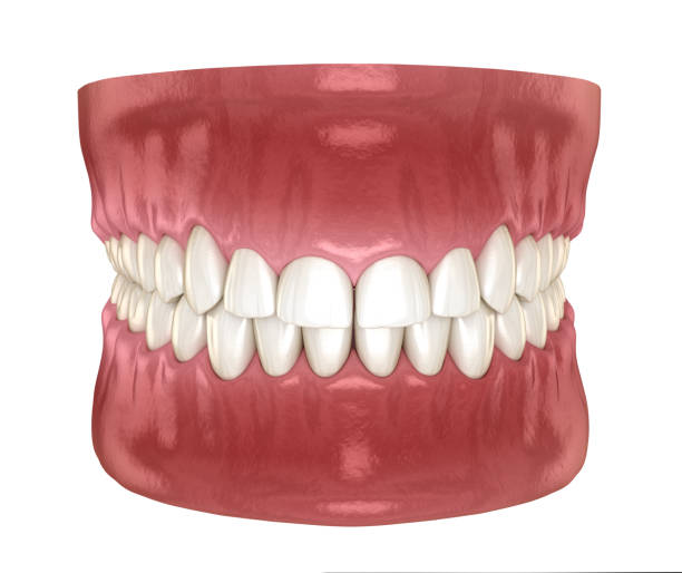 istock Frontal crown lengthening, Esthetic surgery. Medically accurate dental 3D illustration 1279174336