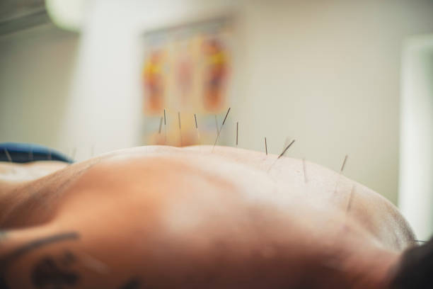 istock Trying out the acupuncture 1279240512