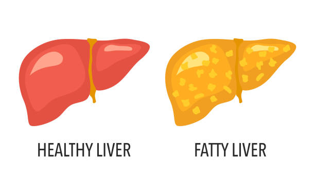 illustrations, cliparts, dessins animés et icônes de comparaison d’une maladie saine du foie et du foie gras. illustration vectorielle de concept de soins de santé humaine sur le fond blanc. - unhealthy eating