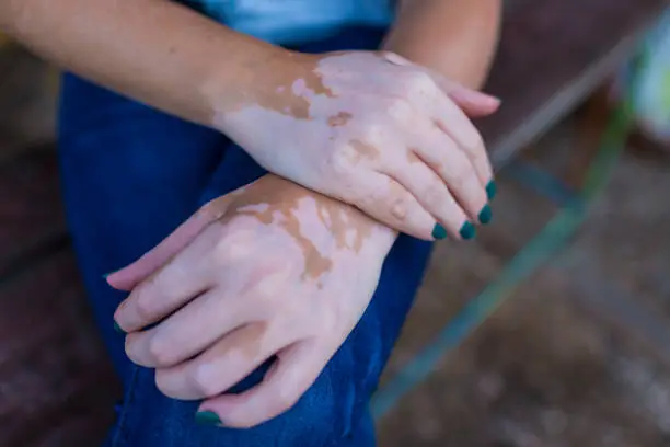 Photo of Closeup of Female Hands With Vitiligo Disease. Horizontal Image Composition