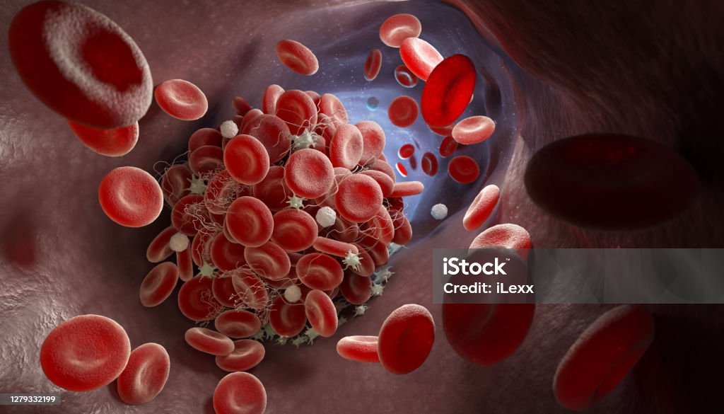 Formation of a blood clot Depiction of a blood clot forming inside a blood vessel. 3D illustration Blood Clot Stock Photo