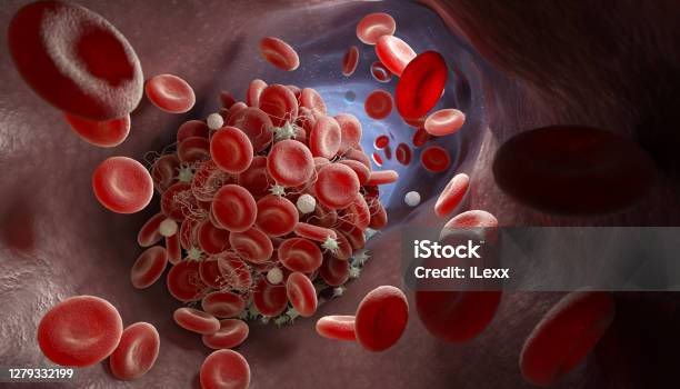 Formation Of A Blood Clot Stock Photo - Download Image Now - Blood Clot, Blood, Biological Cell