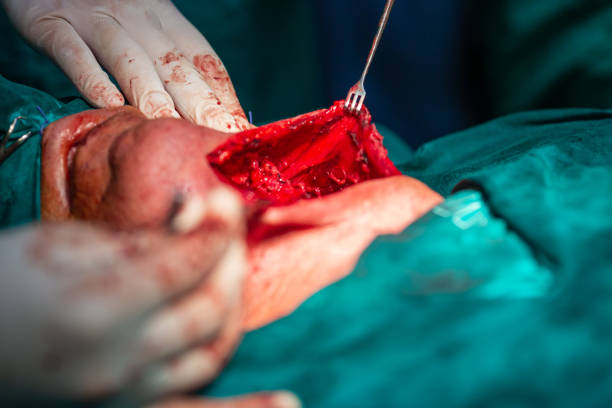 хирургия сонной артерии шеи - surgery human artery human hand carotid artery стоковые фото и изображения