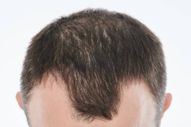 istock Man losing hair on head 1279629905