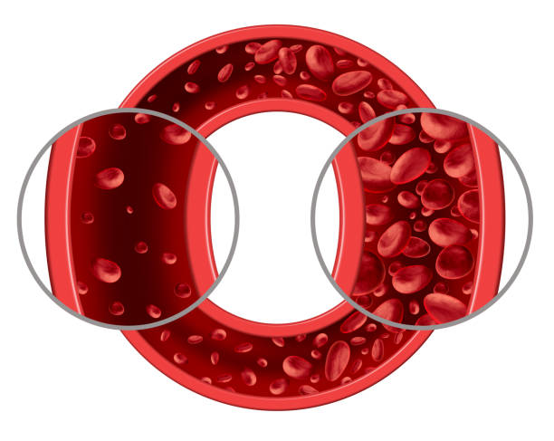 Anemia Blood Disease Anemia and anaemia medical diagram concept as normal and abnormal blood cell count and human circulation in an artery or vein as a 3D illustration isolated on a white background. anemia photos stock pictures, royalty-free photos & images