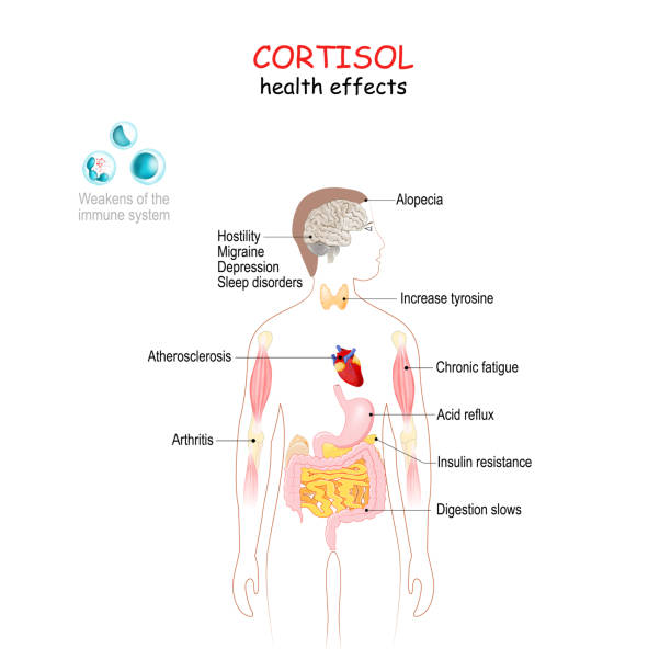 Cortisol health effects. Human's body with internal organs affected by cortisol. Cortisol health effects. Human's body with internal organs affected by cortisol. Decreases of metabolism, Insulin resistance, Digestion slows, Acid reflux, Increase tyrosine, and Weakens of the immune system, atherosclerosis, arthritis, alopecia, Chronic fatigue, Hostility, Migraine, Depression, Sleep disorders tyrosine stock illustrations