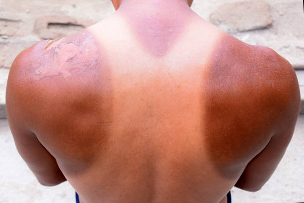 extra sun-scorched shoulders and neck skin, the body part between the lateral upper joint of the human arm and the neck, reaction to injury or infection - upper arm fotos imagens e fotografias de stock