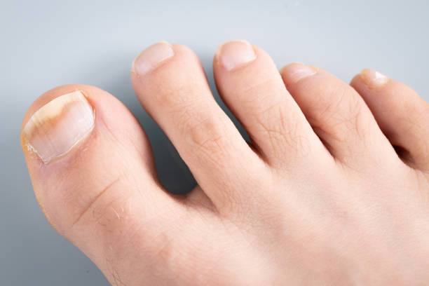 爪真菌症, 真菌症の初期段階.真菌菌に感染した大きなつま先 - fungus toenail human foot onychomycosis ストックフォトと画像