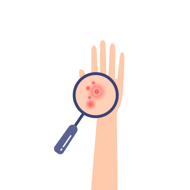 medical examination of redness on the arm medical examination of redness on the arm. increased scheme eczema on human hand. lab diagnostic patient with an allergic reaction like an dermatitis. flat image of skin disease and red rash symptoms skin exame stock illustrations