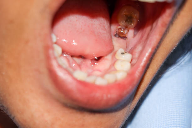 istock Cavities and broken teeth are painful 1280467992