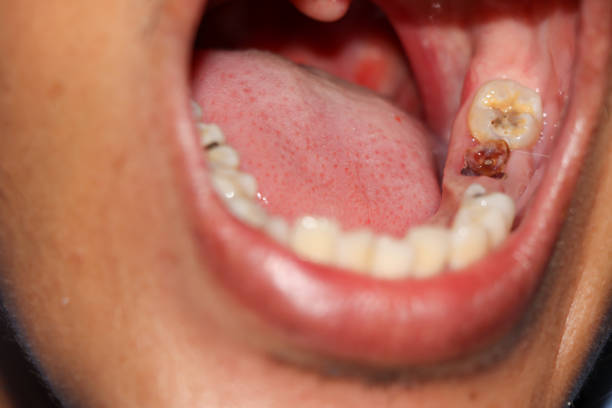 istock Cavities and broken teeth are painful 1280467996
