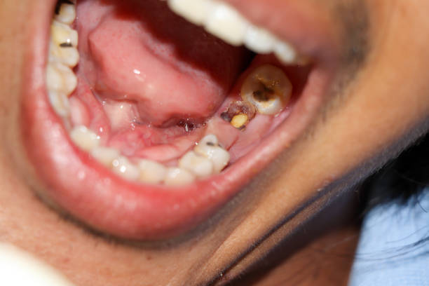 istock Cavities and broken teeth are painful 1280468005