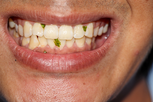 Green vegetables on the teeth