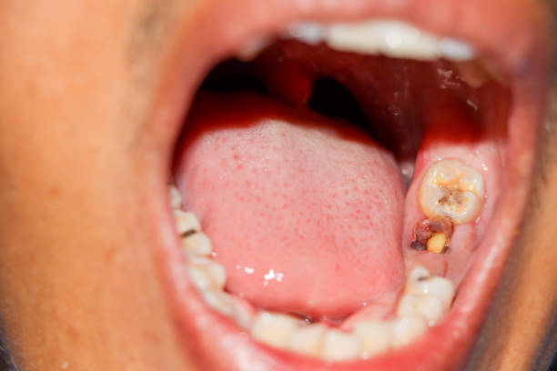 istock Cavities and broken teeth are painful 1280468076