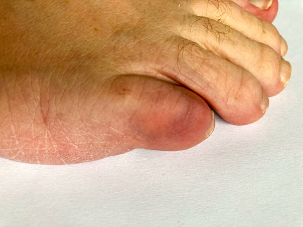 istock Fractured bruised little toe of a senior man 1280477308