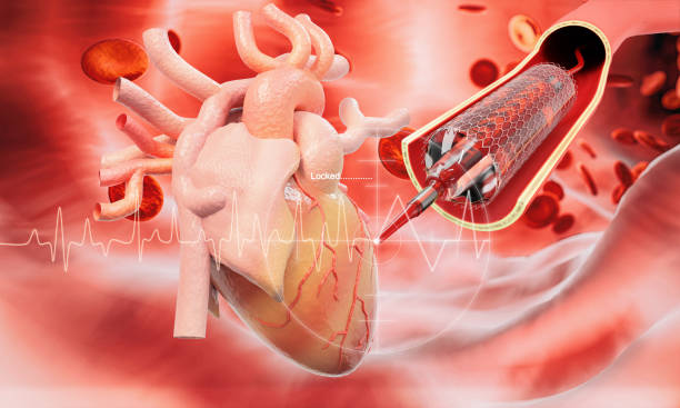 90 Stent Implantation Stock Photos Pictures Royalty Free Images 90 Stent Implantation Stock Photos Pictures Royalty Free Images