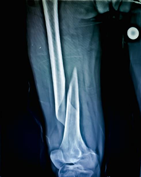 X-Ray of fracture right thigh in 50 year old male X-ray of fracture right thigh in 50 year old male femur photos stock pictures, royalty-free photos & images
