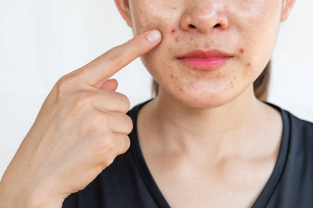 istock Woman pointing problems of acne inflamed on her face. 1280837903