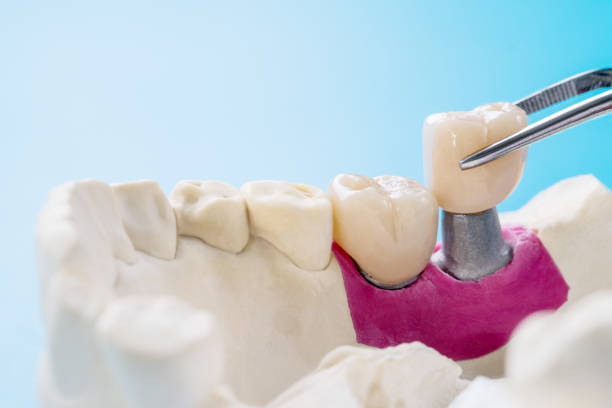 istock Implant Prosthodontics or Prosthetic 1280992579