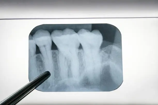 Photo of film x-ray of a mouth.