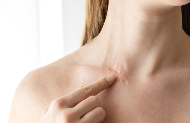 cicatrices de cirugía en el cuello de la mujer - scar fotografías e imágenes de stock