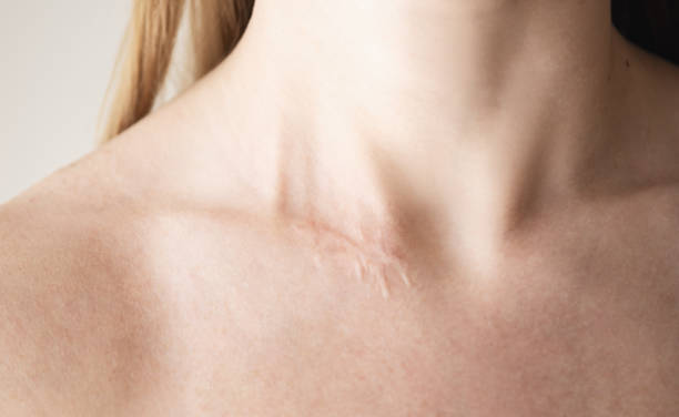 istock Surgery scar on woman neck 1281316338