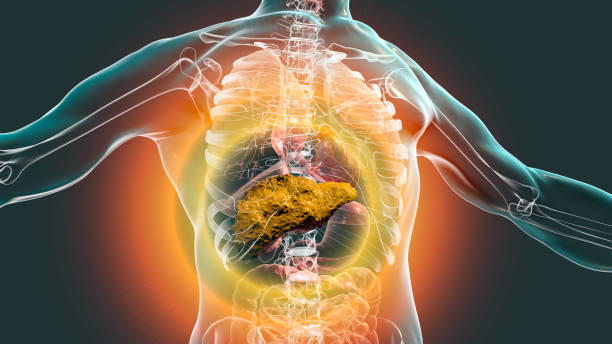 Liver with cirrhosis inside human body Liver with cirrhosis inside human body. 3D illustration cirrhosis stock pictures, royalty-free photos & images