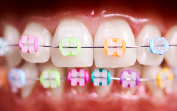 istock Orthodontic brackets with rubber bands on patient teeth. 1281462834