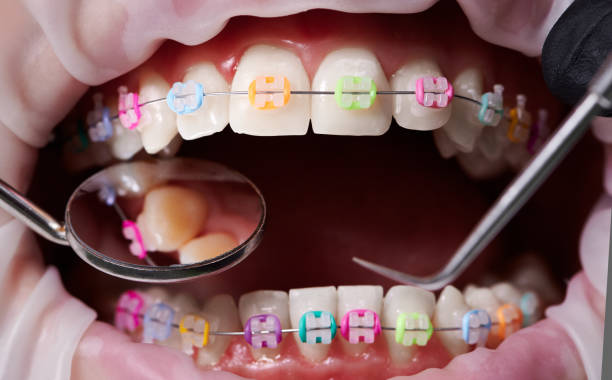 istock Dental procedure, process of attaching white ceramic braces with a help of colorful rubber bands 1281462845