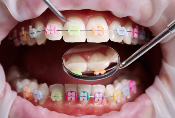 istock Orthodontist examining patient braces with dental instruments. 1281462849