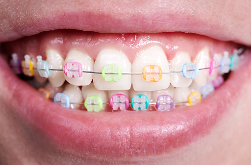 Horizontal closeup snapshot of beautiful woman's smile, demonstrating white healthy teeth with ceramic brackets, united with wire and colorful rubber bands. Front view. Orthodontic accessories concept