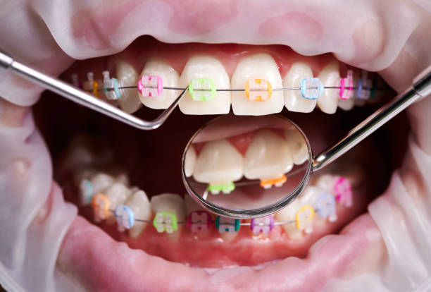istock Orthodontist examining patient braces with dental instruments. 1281462857