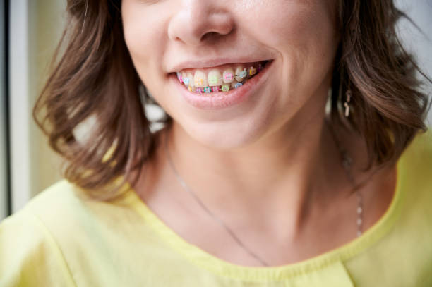 istock Young woman demonstrating teeth with orthodontic braces. 1281462909