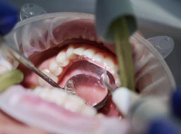 istock Orthodontist doing professional teeth cleaning in dental clinic. 1281464590