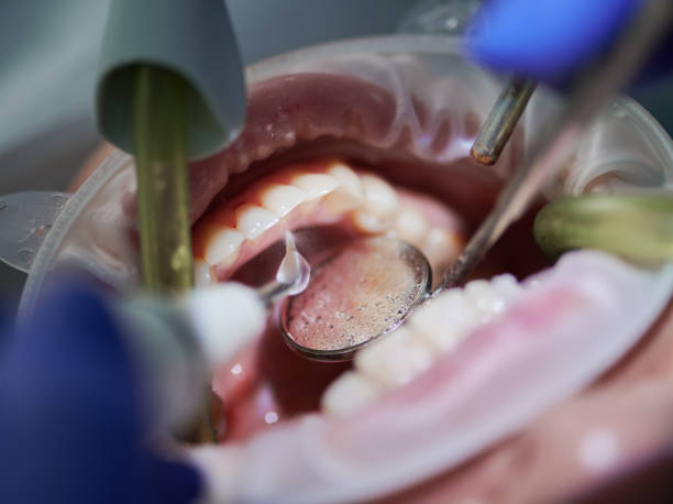 istock Orthodontist doing professional teeth cleaning in dental clinic. 1281464595