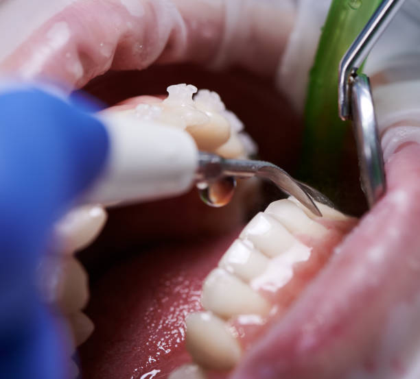 istock Doctor doing professional teeth cleaning in dental clinic 1281464597