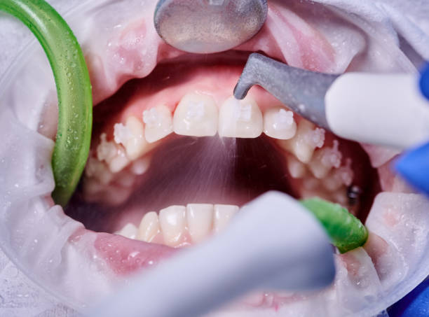 istock Doctor doing professional teeth cleaning in dental clinic 1281464606