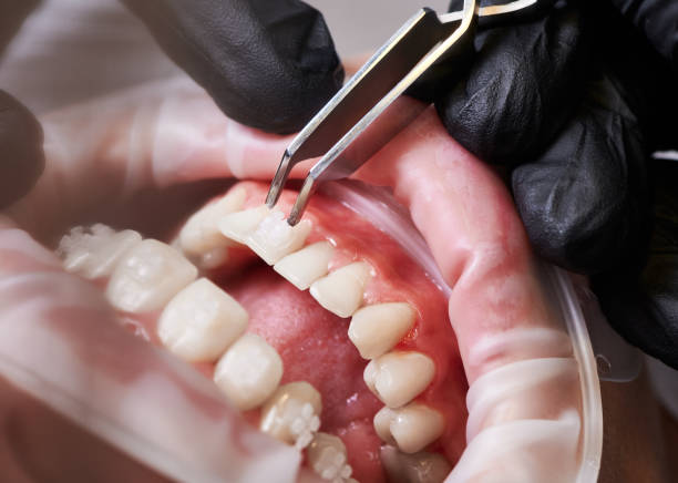 istock Dentist attaching orthodontic brackets to patient teeth. 1281464646