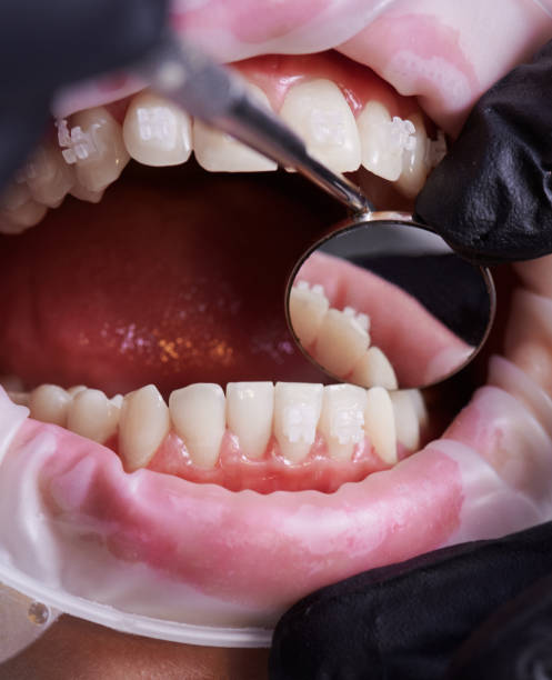 istock Dentist's hand checking patient's lower teeth with a help of mirror. 1281464658