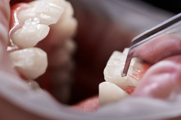 istock Orthodontist attaching white braces to patient teeth. 1281464682