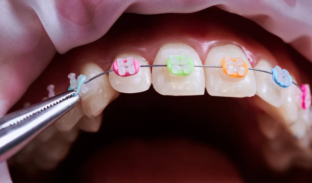 istock Dentist removing rubber bands from patient braces. 1281464720