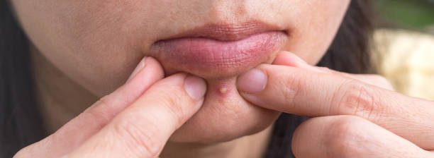 istock Portrait of Pimple 1281467693