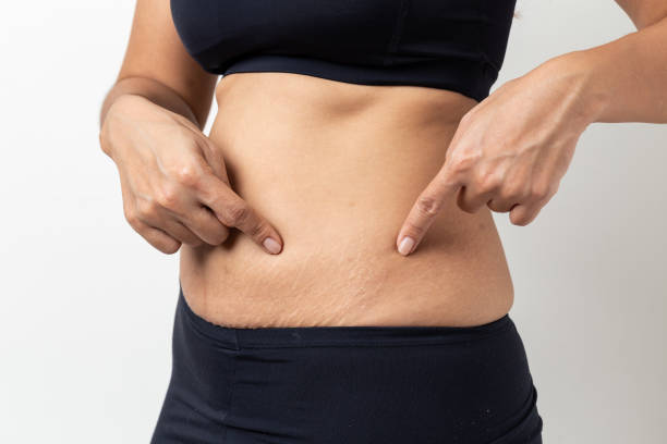 istock Stretch Marks, Women Show off the belly after birth on white background 1281472201