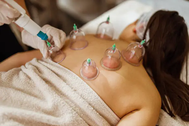 Young woman lying down in the beauty clinic and having a cupping massage body treatment to improve blood circulation and remove body toxins